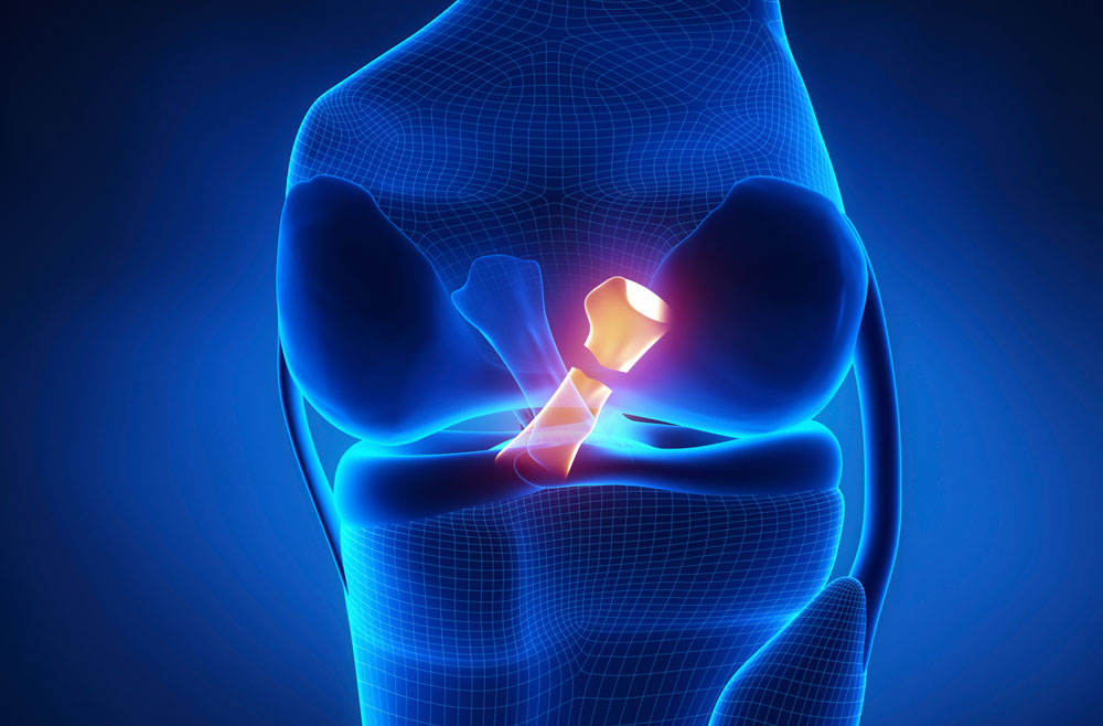 posterior-cruciate-ligament-injury-pcl-symptoms-and-causes